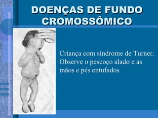 DOENÇAS DE FUNDODOENÇAS DE FUNDO
CROMOSSÔMICOCROMOSSÔMICO
Criança com síndrome de Turner.
Observe o pescoço alado e as
mãos e pés entufados
 