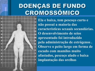 DOENÇAS DE FUNDODOENÇAS DE FUNDO
CROMOSSÔMICOCROMOSSÔMICO
Ela e baixa, tem pescoço curto e
não possui a maioria das
características sexuais secundárias.
O desenvolvimento de seios
apresentado foi introduzido
pela administração de estrógenos .
Observe o peito largo em forma de
escudo com mamilos muito
afastados, pescoço alado e baixa
implantação das orelhas
 