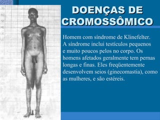 DOENÇAS DEDOENÇAS DE
CROMOSSÔMICOCROMOSSÔMICO
Homem com síndrome de Klinefelter.
A síndrome inclui testículos pequenos
e muito poucos pelos no corpo. Os
homens afetados geralmente tem pernas
longas e finas. Eles freqüentemente
desenvolvem seios (ginecomastia), como
as mulheres, e são estéreis.
 