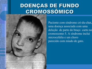 DOENÇAS DE FUNDODOENÇAS DE FUNDO
CROMOSSÔMICOCROMOSSÔMICO
Paciente com síndrome cri-du-chat,
uma doença associada com uma
deleção de parte do braço curto no
cromossomo 5. A síndrome inclui
microcefalia e um choro
parecido com miado de gato.
 