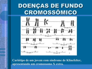 DOENÇAS DE FUNDODOENÇAS DE FUNDO
CROMOSSÔMICOCROMOSSÔMICO
Cariótipo de um jovem com síndrome de Klinefelter,
apresentando um cromossomo X extra.
 