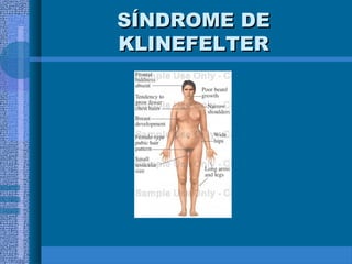 SÍNDROME DESÍNDROME DE
KLINEFELTERKLINEFELTER
 