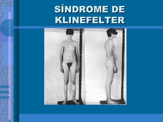 SÍNDROME DESÍNDROME DE
KLINEFELTERKLINEFELTER
 
