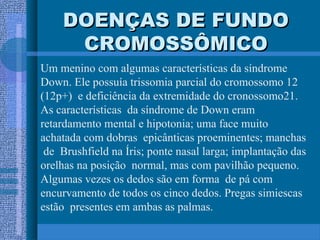 DOENÇAS DE FUNDODOENÇAS DE FUNDO
CROMOSSÔMICOCROMOSSÔMICO
Um menino com algumas características da síndrome
Down. Ele possuía trissomia parcial do cromossomo 12
(12p+) e deficiência da extremidade do cronossomo21.
As características da síndrome de Down eram
retardamento mental e hipotonia; uma face muito
achatada com dobras epicânticas proeminentes; manchas
de Brushfield na Íris; ponte nasal larga; implantação das
orelhas na posição normal, mas com pavilhão pequeno.
Algumas vezes os dedos são em forma de pá com
encurvamento de todos os cinco dedos. Pregas simiescas
estão presentes em ambas as palmas.
 