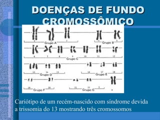 DOENÇAS DE FUNDODOENÇAS DE FUNDO
CROMOSSÔMICOCROMOSSÔMICO
Cariótipo de um recém-nascido com síndrome devida
a trissomia do 13 mostrando três cromossomos
 