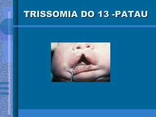 TRISSOMIA DO 13 -PATAUTRISSOMIA DO 13 -PATAU
 