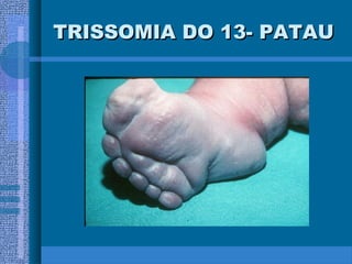 TRISSOMIA DO 13- PATAUTRISSOMIA DO 13- PATAU
 