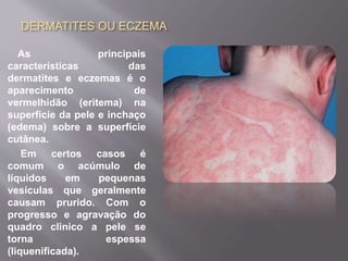 DERMATITES OU ECZEMA 
As principais 
características das 
dermatites e eczemas é o 
aparecimento de 
vermelhidão (eritema) na 
superfície da pele e inchaço 
(edema) sobre a superfície 
cutânea. 
Em certos casos é 
comum o acúmulo de 
líquidos em pequenas 
vesículas que geralmente 
causam prurido. Com o 
progresso e agravação do 
quadro clinico a pele se 
torna espessa 
(liquenificada). 
 