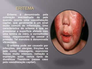 ERITEMA 
Eritema é denominado pela 
coloração avermelhada da pele 
quando ocorre uma vasodilatação 
capilar, que geralmente é um sinal 
muito comum de inflamação. Uma 
característica do eritema é que ao 
pressionar a superfície afetada com 
uma lamina de vidro, a vermelhidão 
cessa, reaparecendo ao cessar a 
pressão. Tal manobra é denominada 
vitroscopia. 
O eritema pode ser causado por 
infecções, por alergias, fricções na 
pele como massagens, exercícios 
físicos muito intensos, radiação e 
exposição solar, certos tipos de 
diuréticos Tiazidicos (nesse caso 
pela vasodilatação capilar). 
 