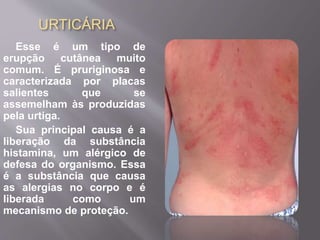 URTICÁRIA 
Esse é um tipo de 
erupção cutânea muito 
comum. É pruriginosa e 
caracterizada por placas 
salientes que se 
assemelham às produzidas 
pela urtiga. 
Sua principal causa é a 
liberação da substância 
histamina, um alérgico de 
defesa do organismo. Essa 
é a substância que causa 
as alergias no corpo e é 
liberada como um 
mecanismo de proteção. 
 