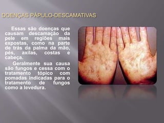 DOENÇAS PÁPULO-DESCAMATIVAS 
Essas são doenças que 
causam descamação da 
pele em regiões mais 
expostas, como na parte 
de trás da palma da mão, 
pés, axilas, costas e 
cabeça. 
Geralmente sua causa 
são fungos e cessa com o 
tratamento tópico com 
pomadas indicadas para o 
tratamento de fungos 
como a levedura. 
