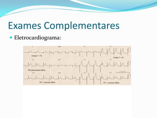 Exames Complementares
 Eletrocardiograma:
 