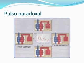 Pulso paradoxal
 