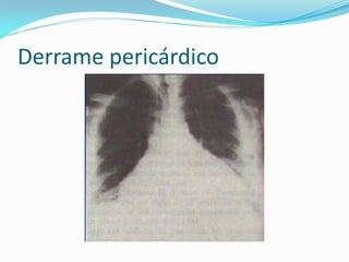 Derrame pericárdico
 