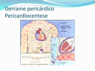 Derrame pericárdico
Pericardiocentese
 