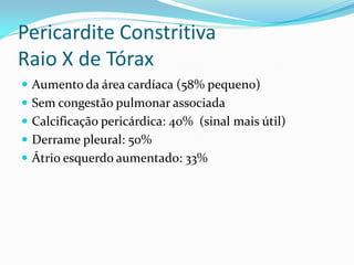 Pericardite Constritiva
Raio X de Tórax
 Aumento da área cardíaca (58% pequeno)
 Sem congestão pulmonar associada
 Calcificação pericárdica: 40% (sinal mais útil)
 Derrame pleural: 50%
 Átrio esquerdo aumentado: 33%
 