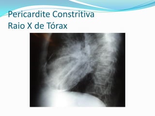 Pericardite Constritiva
Raio X de Tórax
 