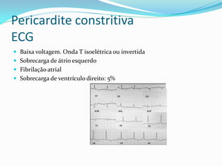 Pericardite constritiva
ECG
 Baixa voltagem. Onda T isoelétrica ou invertida
 Sobrecarga de átrio esquerdo
 Fibrilação atrial
 Sobrecarga de ventrículo direito: 5%
 