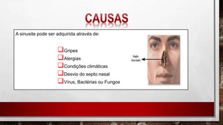 A sinusite pode ser adquirida através de:
Gripes
Alergias
Condições climáticas
Desvio do septo nasal
Vírus, Bactérias ou Fungos
 