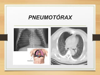 PNEUMOTÓRAX
 