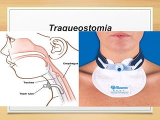 Traqueostomia
 