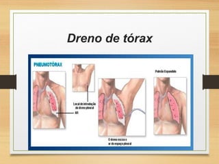Dreno de tórax
 