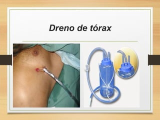 Dreno de tórax
 