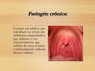 Faringite crônica:Faringite crônica:
 