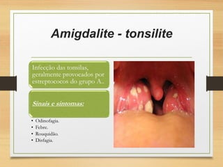 Amigdalite - tonsilite
 