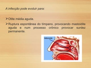A infecção pode evoluir para:
Otite média aguda.
Ruptura espontânea do tímpano, provocando mastoidite
aguda e num processo crônico provocar surdez
permanente.
 