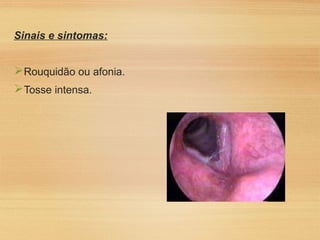 Sinais e sintomas:
Rouquidão ou afonia.
Tosse intensa.
 