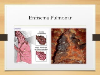 Enfisema Pulmonar
 