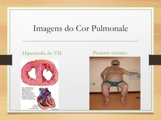 Imagens do Cor Pulmonale
Hipertrofia do VD Paciente crônico
 
