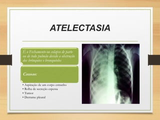 ATELECTASIA
 