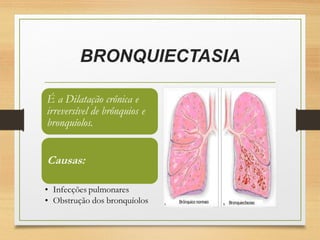 BRONQUIECTASIA
 