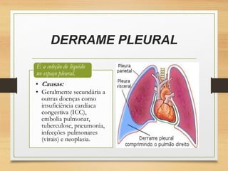 DERRAME PLEURAL
 