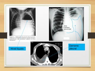 Nível líquido
Derrame
pleural
Área
Cardíaca
aproximada
 