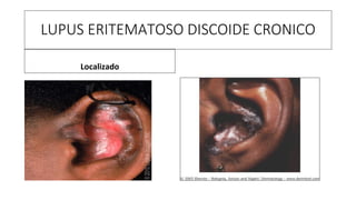 LUPUS ERITEMATOSO DISCOIDE CRONICO
Localizado
 