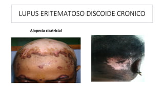 LUPUS ERITEMATOSO DISCOIDE CRONICO
Alopecia cicatricial
 