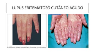 LUPUS ERITEMATOSO CUTÂNEO AGUDO
 