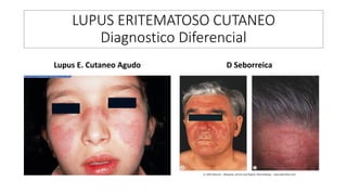 LUPUS ERITEMATOSO CUTANEO
Diagnostico Diferencial
Lupus E. Cutaneo Agudo D Seborreica
 
