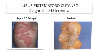 LUPUS ERITEMATOSO CUTANEO
Diagnostico Diferencial
Lupus E.C. Subagudo Psoriase
 