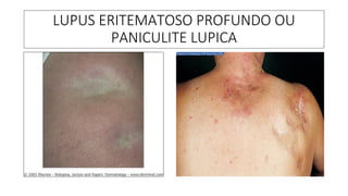 LUPUS ERITEMATOSO PROFUNDO OU
PANICULITE LUPICA
 