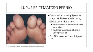 LUPUS ERITEMATOSO PERNIO
• Caracteriza-se por pápulas e
placas violáceas acrais (face,
dedos das mãos e pés)
• desencadeadas ou exacerbadas
pelo frio,
• podem evoluir com atrofia e
telangiectasias
• Em 20% dos casos evolui para
LES
 