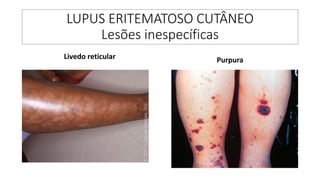 LUPUS ERITEMATOSO CUTÂNEO
Lesões inespecíficas
Livedo reticular Purpura
 
