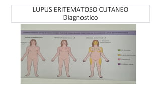 LUPUS ERITEMATOSO CUTANEO
Diagnostico
 