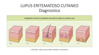 LUPUS ERITEMATOSO CUTANEO
Diagnostico
 