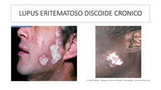 LUPUS ERITEMATOSO DISCOIDE CRONICO
 