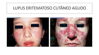 LUPUS ERITEMATOSO CUTÂNEO AGUDO
 