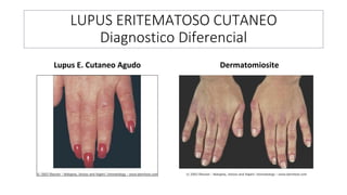 LUPUS ERITEMATOSO CUTANEO
Diagnostico Diferencial
Lupus E. Cutaneo Agudo Dermatomiosite
 